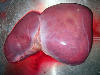 JustMasondo's tweet image. Here&apos;s a Healthy Liver VS A liver damaged by Alcohol

RT for awareness