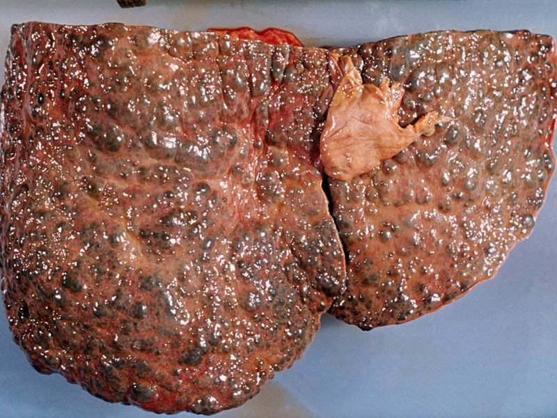 JustMasondo's tweet image. Here&apos;s a Healthy Liver VS A liver damaged by Alcohol

RT for awareness