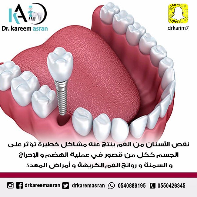 نقص #الاسنان من #الفم ينتج عنه مشاكل خطيره تؤثر علي الجسم

#عدسات_اسنان
#تقويم_اسنان
#زراعة_اسنان