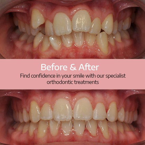 dsorthodontics's tweet photo. Here's just one example of our before and after cases at DSO. You can find confidence in your smile with our specialist orthodontic treatments too! #dso #devonsquareorthodontics #devonsquare #orthodontics #orthodontists #dental #teeth #smile #tooth #tbt #braces https://t.co/7ZDhTS6amj