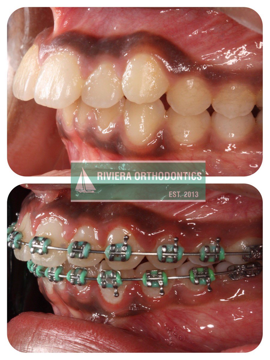 If you wear your rubber bands, you WILL see results! #dentistry #braces