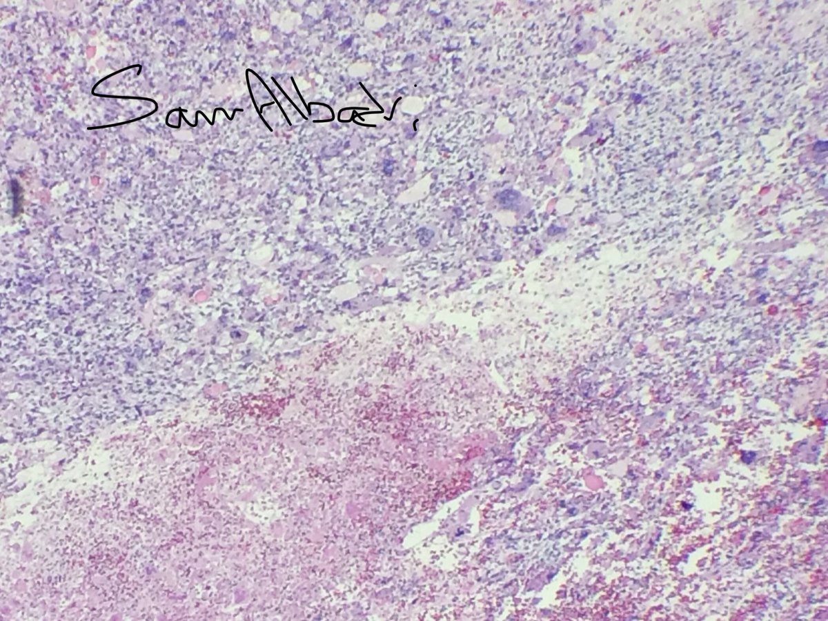 sam_albadri's tweet photo. 10 YM liver mass w large multinucleated tumor cells with intracytoplasmic hyaline droplets 💧 “🌟undifferentiated embryonal sarcoma🌟” @MayoClinicPath @marenwhymd @pembeoltulu @DoraGIPath @suraksharaob @HHPathology @UTSW_GIpath @RoseannIWu @yalepathology @EAljufairi #pathobard https://t.co/WVz0aYQEQT