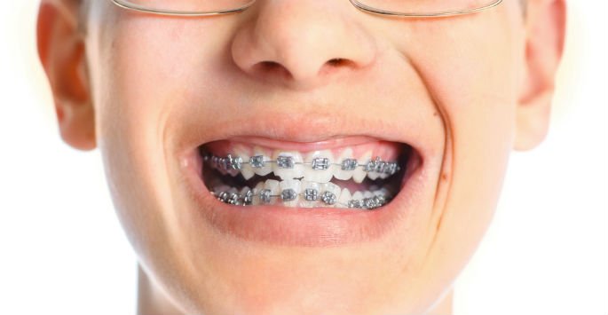 Are you interested in getting your child in #Braces? We can help! #Destin bit.ly/2Ew81K2