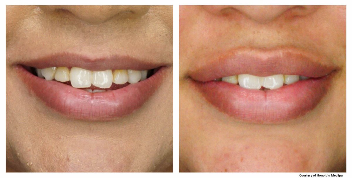 honolulumedspa's tweet photo. Join us for a special event, May 17th from 5:30-7:30pm as we share our secrets on all things #Lips 👄 Get the inside scoop on lip injections + #LipLase and why our patients are loving the combo! For those of you that might not be into the 💉💉💉 we have some special offers avail. https://t.co/6dcniJWn8L