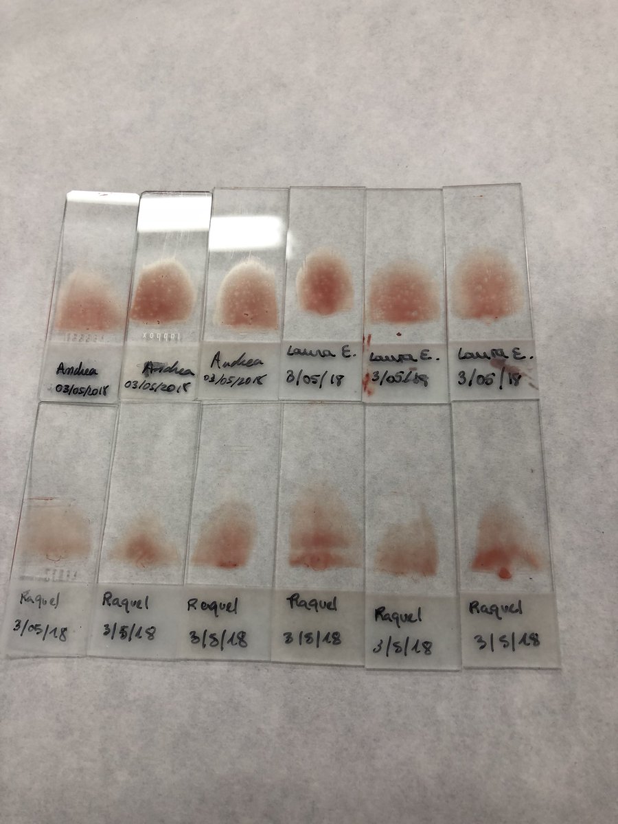 MagiclabTfn's tweet photo. També em continuat amb les nostres pràctiques avui ha sigut una practica que necessita practica i paciència les extensións sanguínies sembla fàcil però no ho es tant.Pero ho seguirem intentant💉@jesuitesFP #LAB1719 #LaNovaFP https://t.co/3AmizQWKYG