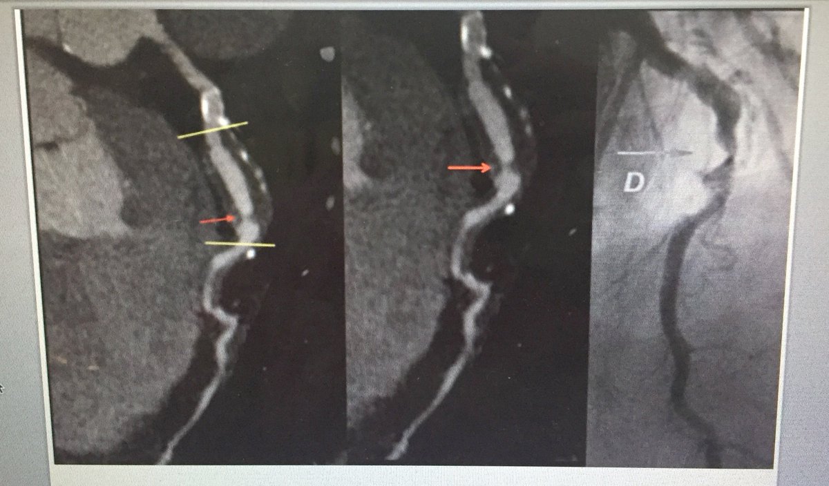 CardioScan_tele's tweet photo. 🔺 angiotc de coronárias: placa não calcificada, remodelamento positivo e estenose importante (seta vermelha) 🔹 à direita: cate confirmando os achados
#CardioScan #telerradiologia #cardiovascular #tomografia #angiotcdecoronarias #ccta #cardiologia #medicina #radiologia #JPR2018 https://t.co/CVQSPx9Tz8