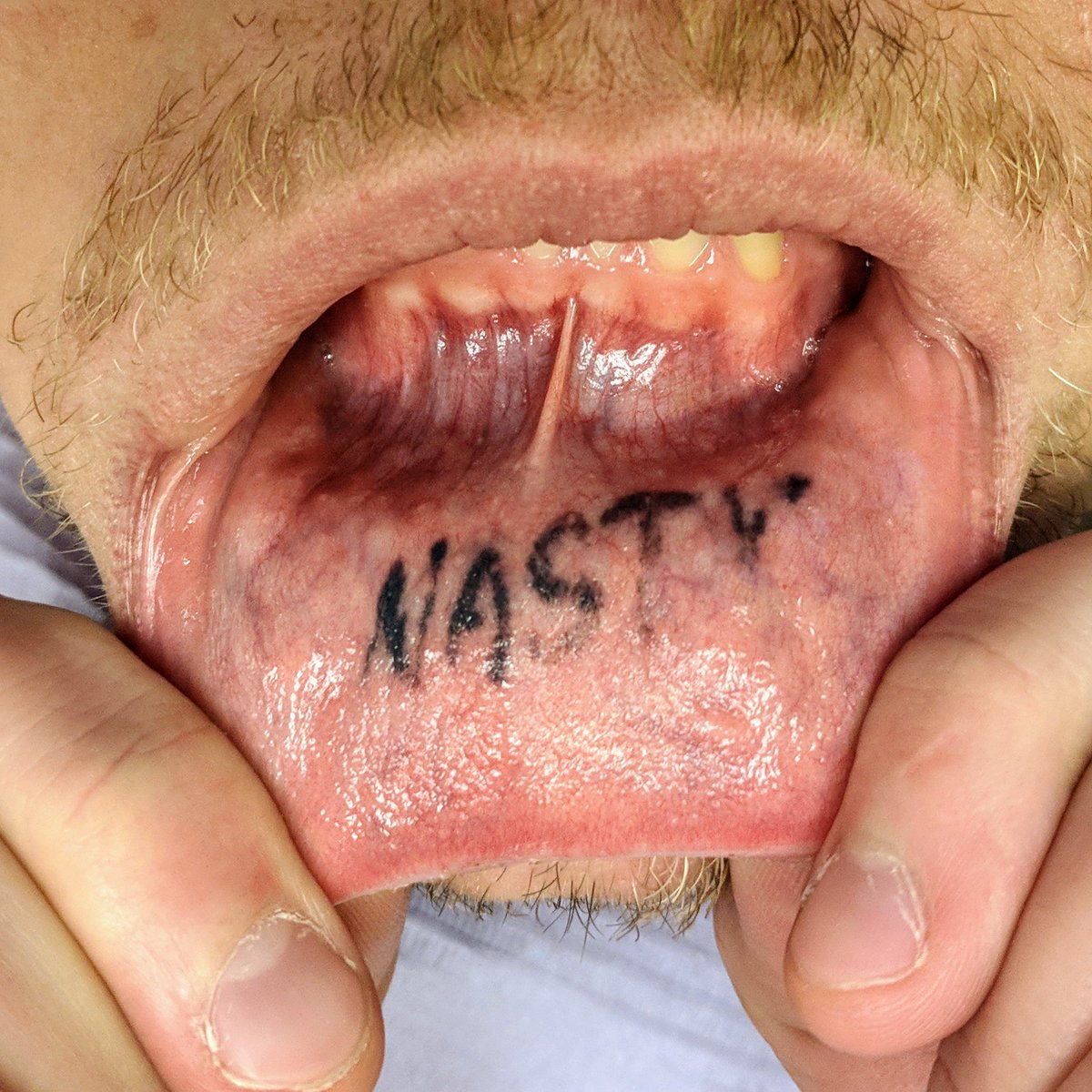 dentalelements's tweet photo. #nasty
What are your thoughts on lip tattoos? (as seen on a patient today)
#dental #dentist #dds #dentistry #dentistrylife #oralhealth #dentalelements #teeth #tooth #smile #lip #lips #tattoo #tattoos #tattooideas #tattoomodel #tattooist #tattooing #liptattoo #liptattoos https://t.co/fvrbZC9jjH
