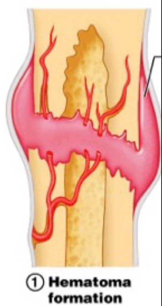 1thefunnybone1's tweet photo. This is my first step on the road to a healed fracture. I have developed a hematoma. Hema meaning blood and toma meaning tumor. This is just the congregation of blood outside of the vessels due to trauma. It’s not super serious so I’ll be fine. One to the next stage! ⏭ https://t.co/iVp0PIxMpe
