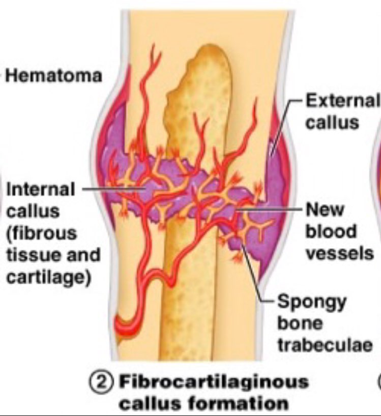 1thefunnybone1's tweet photo. This is a cool stage in my healing process. A ton of fibroblasts and chondroblasts have gathered with sympathy cards in an effort to make me feel better. This is called fibrocartilage callus and it’s temporary. Later my friends become dormant in the new extracellular matrix. https://t.co/3QSGxlkOJP