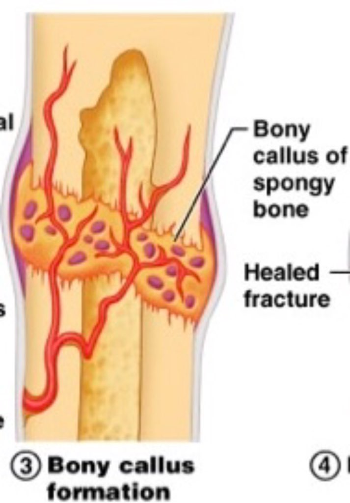 1thefunnybone1's tweet photo. Next comes the formation of boney callus! This is fun because it’s similar to the calluses that my person has from playing tennis all the time. Callus is derived from the Latin root thick skinned. This is the perfect stage for jokes. R/roastme! https://t.co/H4mCwq7w4t