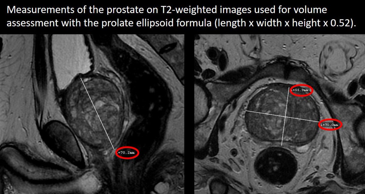 prostate volume radiology