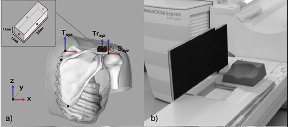 JBiomech's tweet photo. Directional bias of soft-tissue artifacts on the acromion during recording of 3D scapular kinematics
https://t.co/NKz8W0KQMM
#biomechanics https://t.co/wexnI8bBI8