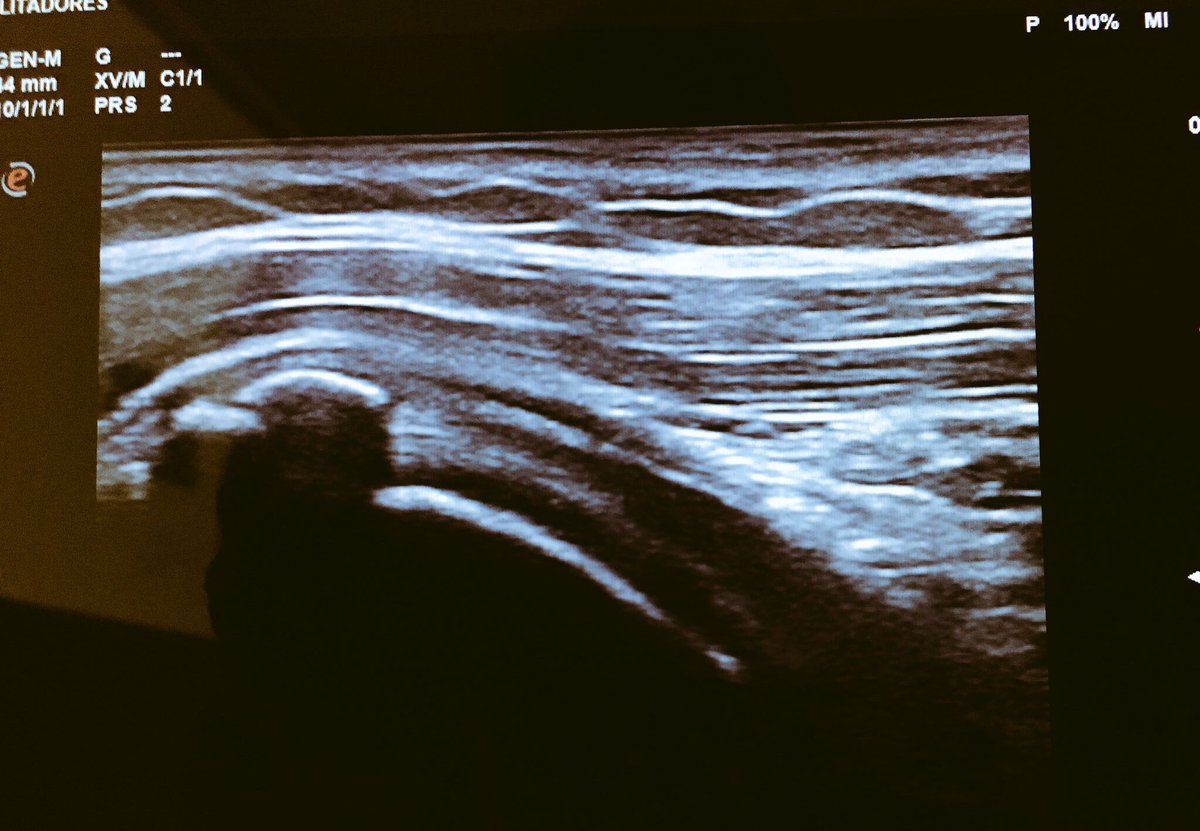 EnriqueFdezpr's tweet photo. Omalgia de larga evolución reagudizada en últimas semanas: Dx Calcificación de tendón subescapular. Se realizó lavado aspiración en el mismo acto.
6 semanas más tarde la paciente se encuentra asintomática. https://t.co/htVbuUtwZD