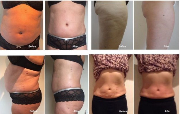 SkinRepairClnk's tweet photo. #Retweet #follo4follo #Video #post  #skin #repair #Clinic #Latest #NonSurgical #SkinTreatment #LipoFirm #LipoFirmPro #TriLipo #BodySculpting #FatReduction #SkinTightening #London #UK #Best #quality #Price  #special #introductory #discount #Offer https://t.co/Zdcicd6S38 https://t.co/6SvoIeSmYq
