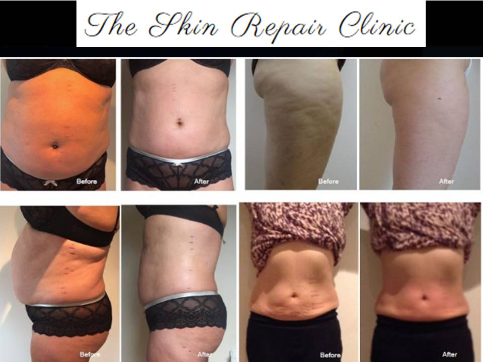 SkinRepairClnk's tweet photo. #Retweet #follo4follo #Video #post  #skin #repair #Clinic #Latest #NonSurgical #SkinTreatment #LipoFirm #LipoFirmPro #TriLipo #BodySculpting #FatReduction #SkinTightening #London #UK #Best #quality #Price  #special #introductory #discount #Offer https://t.co/Zdcicd6S38 https://t.co/fFHGXS39hM
