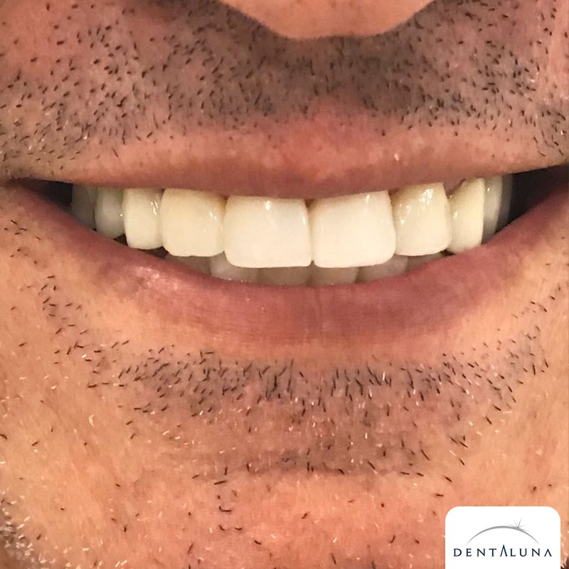Dentaluna's tweet photo. En sevdiğimiz before / after'lardan 😊🙏 https://t.co/XiGKwaKzvr