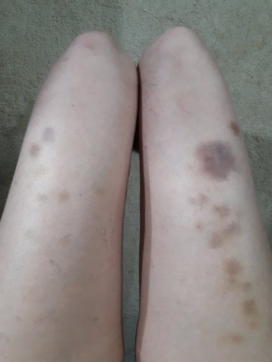 Madame_Absinthe's tweet photo. Sometimes my crafting gets extreme. #icraftharderthanyoucraft #extremecrafting #bruisesfordays https://t.co/ogXYhJ2f1y