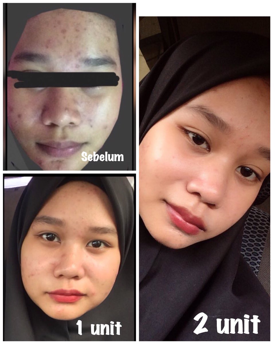 profixforever's tweet photo. Krim #profix ni sis memang RECOMMEND sebab sis pon pakai ok 😘 wajib try kalau nak cantik sebelum raya.  

Whatsapp sis cepat
👉 https://t.co/VXYQMwXtKP https://t.co/SJoKKlOyfs