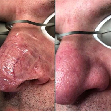 EllipseDK's tweet photo. Great results immediately after treatment!
Thanks to @Ellipse Italia for sharing.
#NordlysbyEllipse #dermatologists #beauty  #Ydun #NdYAG1068 #NearPainFree #ShortPulses https://t.co/wTi2VZ0dGv