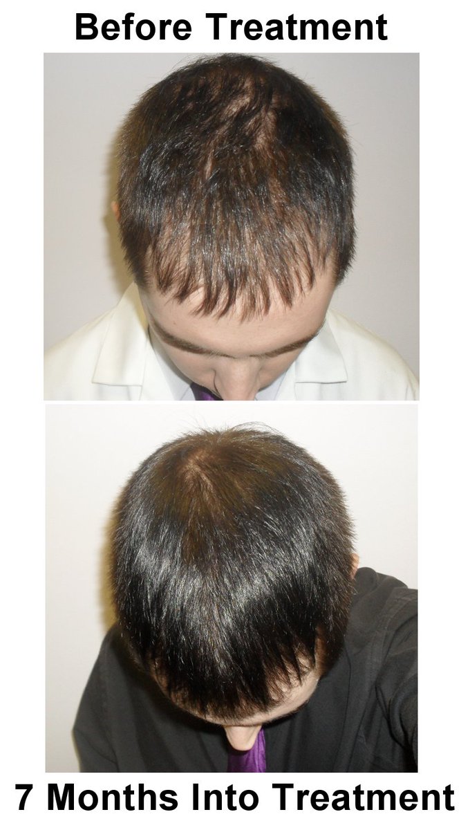 OwnerSellers's tweet photo. Are you interested in buying Hair Loss Laser Restoration Business Package Businesses for sale https://t.co/2nfltqjOsa #Ownersellers #BusinessesForSaleOnline #SellingYourBusinessOnline #hairloss #restoration #laserrestoration #hairandbeauty #NorthYorkshire https://t.co/gD4eiZt5Rq