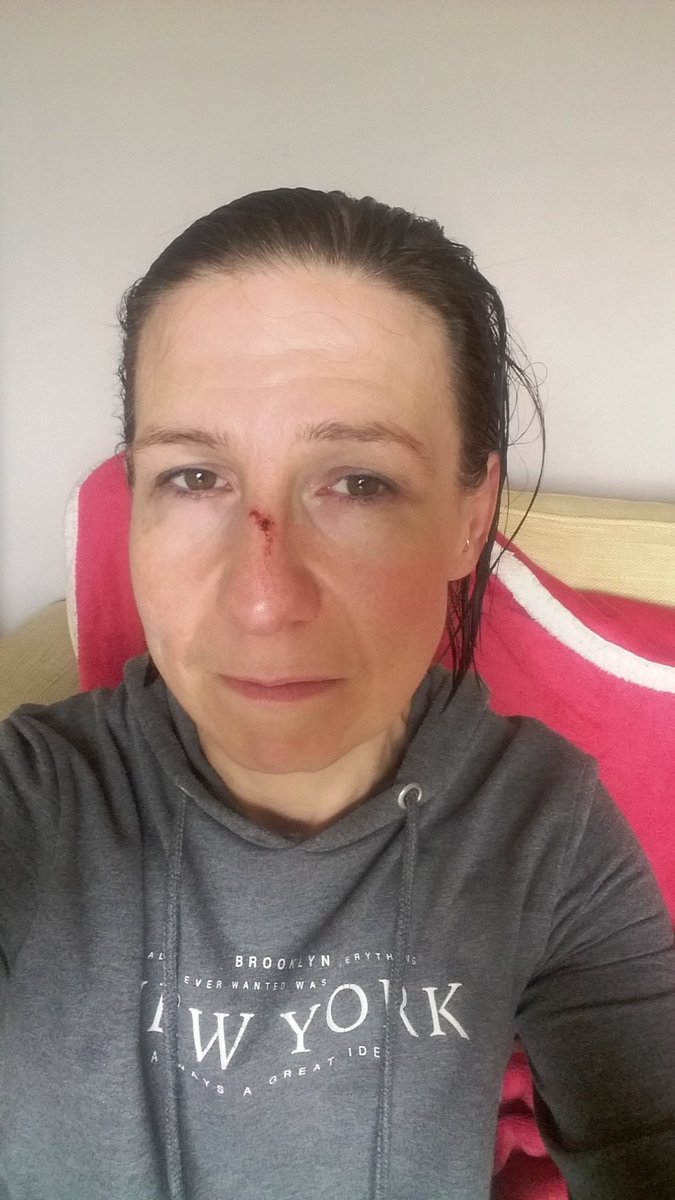 When you potentially fracture your nose 8 days before running your first marathon - gonna have some great looking running pics 😭😭 <a href="/UKRunChat/">UKRunChat</a> <a href="/marathontalk/">Marathon Talk</a> #liverpoolrocknroll #running #marathontraining