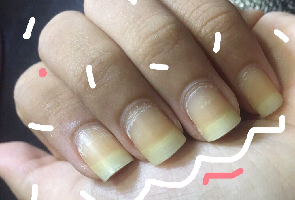 tkxmq_'s tweet photo. เล็บเหลืองไม่ได้เป็นโรค แต่ด้วยความที่ติดชอบทาเล็บ เล็บเลยเหลืองตลอดเว😂😂 แก้ไม่หาย เพื่อนแม่งบังคับซื้อ omgแกไม่ได้คิดว่าจะดีขนาดนี้ น้ำตาจะไหล ขอแชร์นะคะ ใครมีปัญหาเล็บเหลืองแบบเรา คือดีจิง เราใช้กล่องเดียว ซื้อมา190บาท 
#paraffinnailspa #HowtoPerfect #ไว้รีวิวห้ามขายของโว้ยย https://t.co/w6qEX6IdJ3