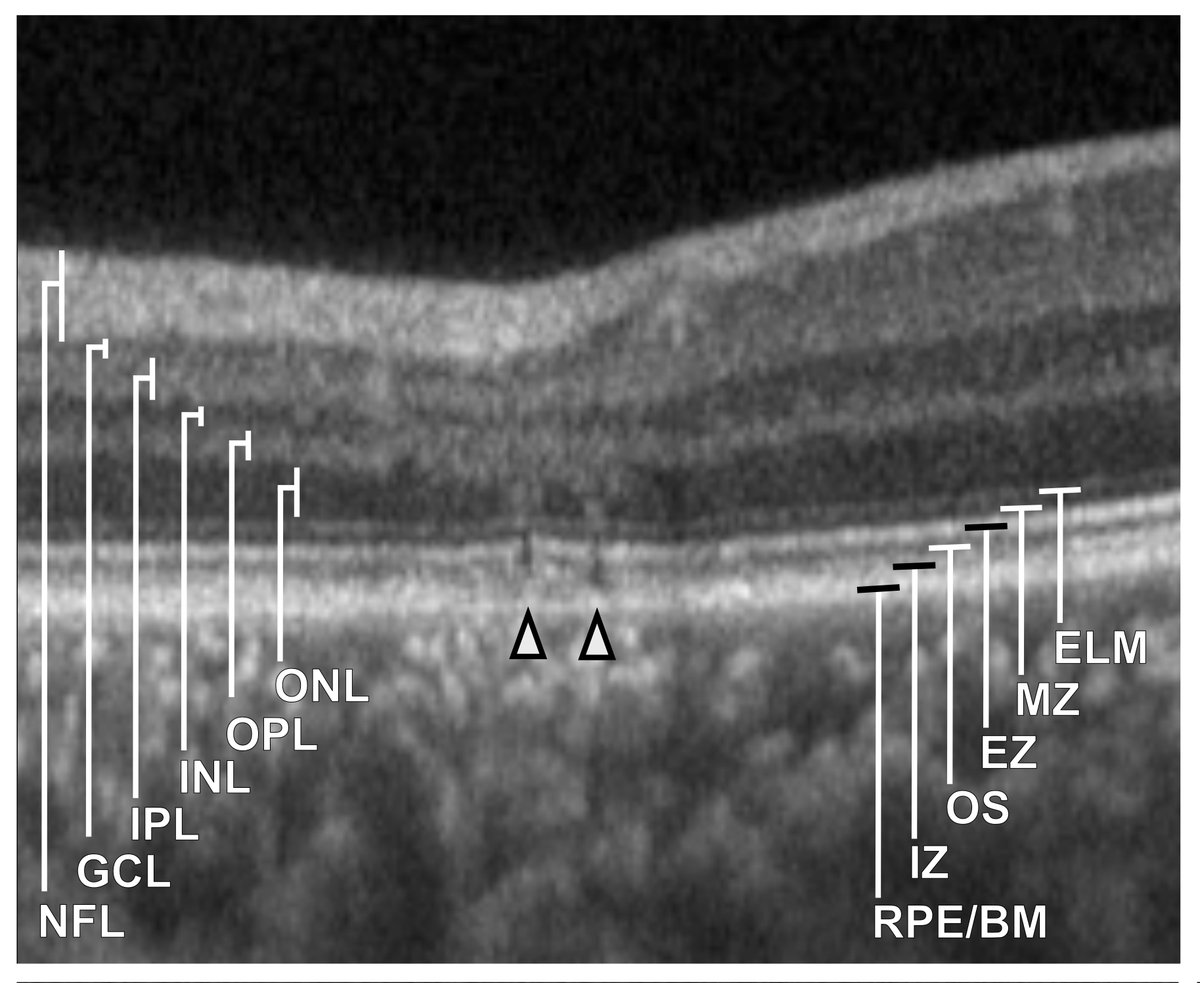 34MHEyeResearch's tweet photo. Our latest research provides an in-depth analysis of the retina scars seen in @Survivors_Ebola https://t.co/vxOM81FW4i https://t.co/Wq07XVQJDy