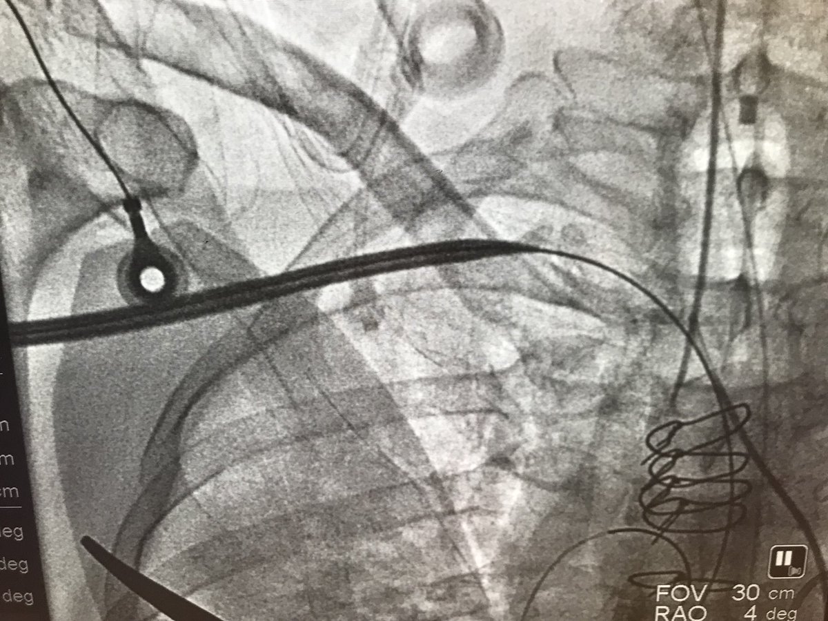 DrAmirKaki's tweet photo. Update:  Neuro recc no cooling. Neuro status amazingly Awake and Alert and Following commands.  CPR clearly was effective. Hemodynamics deteriorated to require 2 pressors, CI 1.8 CPO 0.5 Lacate rose 7.1, MV 41.  Early identification and escalation to CP via Perc Ax. Off pressors https://t.co/jt27Ay9fK1