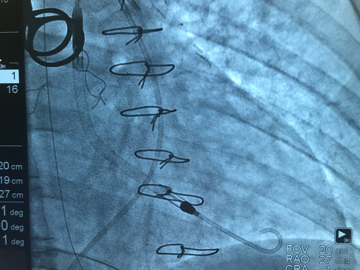 DrAmirKaki's tweet photo. Update:  Neuro recc no cooling. Neuro status amazingly Awake and Alert and Following commands.  CPR clearly was effective. Hemodynamics deteriorated to require 2 pressors, CI 1.8 CPO 0.5 Lacate rose 7.1, MV 41.  Early identification and escalation to CP via Perc Ax. Off pressors https://t.co/jt27Ay9fK1