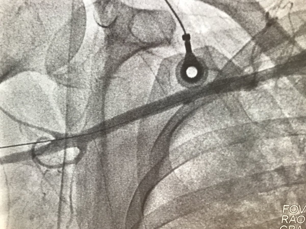 DrAmirKaki's tweet photo. Update:  Neuro recc no cooling. Neuro status amazingly Awake and Alert and Following commands.  CPR clearly was effective. Hemodynamics deteriorated to require 2 pressors, CI 1.8 CPO 0.5 Lacate rose 7.1, MV 41.  Early identification and escalation to CP via Perc Ax. Off pressors https://t.co/jt27Ay9fK1