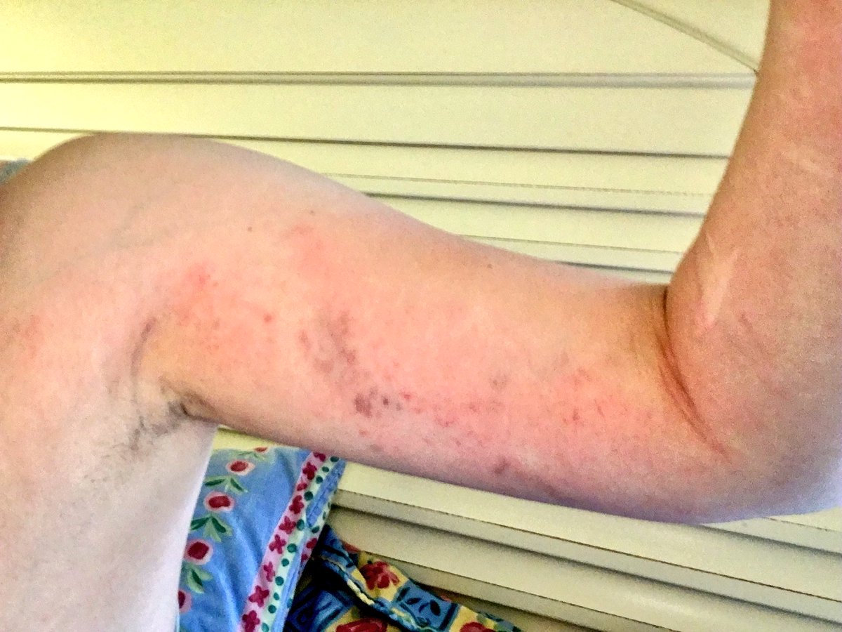 KatMHardy's tweet photo. Conquered my fear of heights and got some battle scars to show for it! I’m a spider monkey now https://t.co/iOxskzXWm3