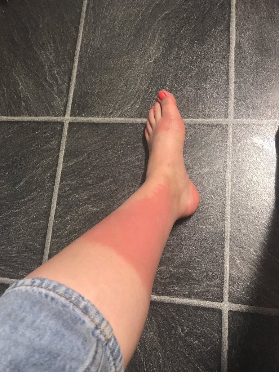 Frankie_rose97's tweet photo. Scoring on your lap, 3 lots of sun cream and still this happen! IM RETIRING! 😩 #scorerproblems #bringbacksnow https://t.co/Hde5PVrziN