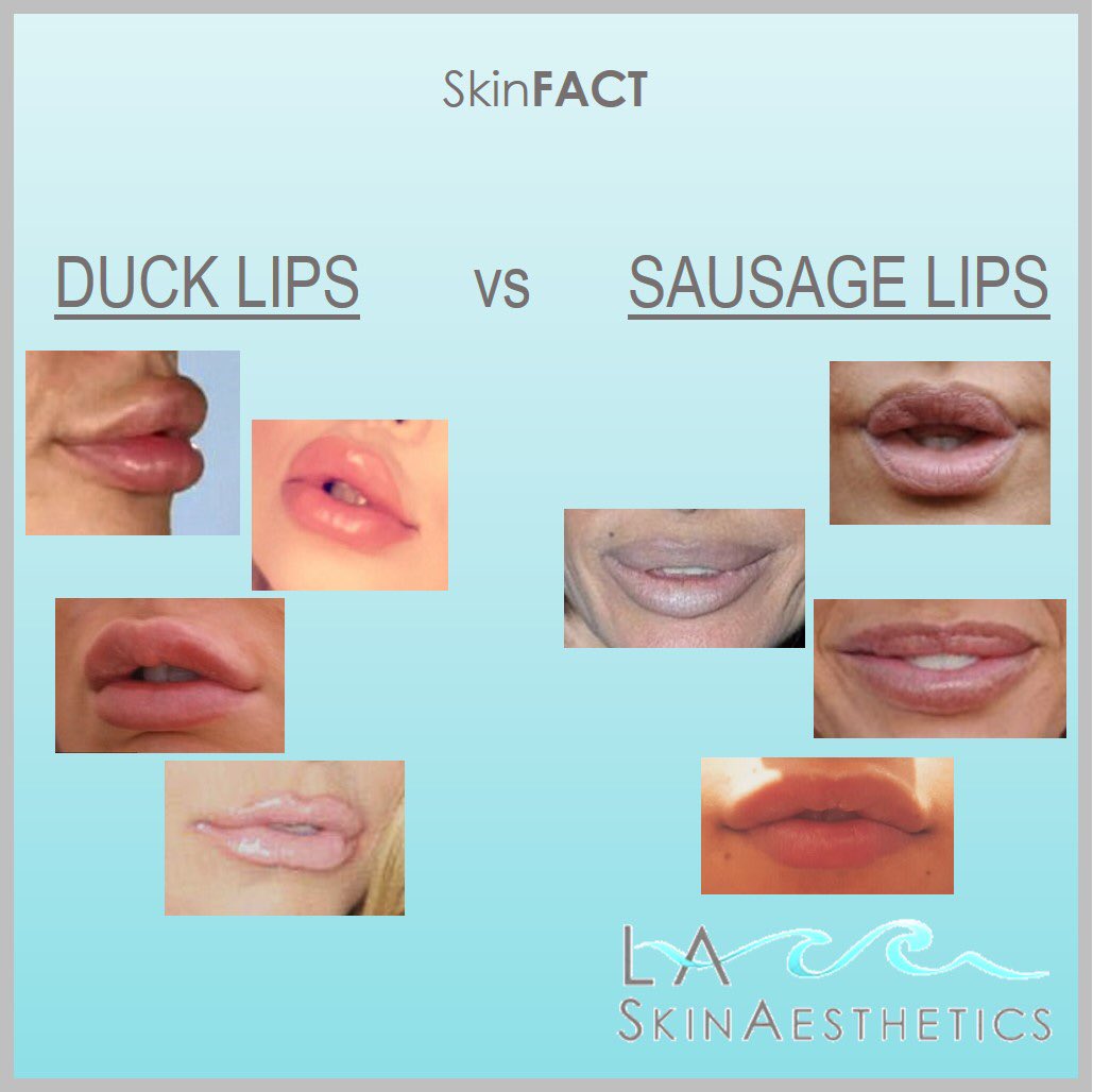 LASkinAesthetic's tweet photo. DUCK LIPS vs SAUSAGE LIPS. What’s the difference? #DuckLips is an outward flip of the lips due to the border being overfilled. #SausageLips, is when the outer corners are overfilled. When too much filler is placed laterally, it will elongate the lips and make them fat &amp; heavy. https://t.co/KbYtPzLkCo