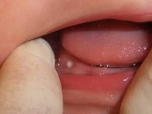 中 赤ちゃん 口 白い の 赤ちゃんの歯茎が白い？考えられる病気とは