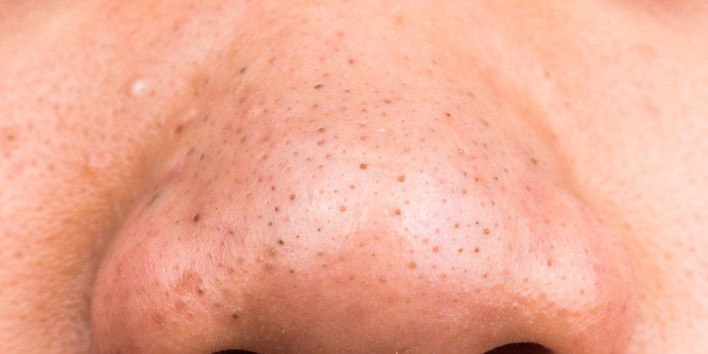 MensHealthMag's tweet photo. How floss can help you remove pesky blackheads: https://t.co/PK8d2jkdqW https://t.co/clYMimpPHY