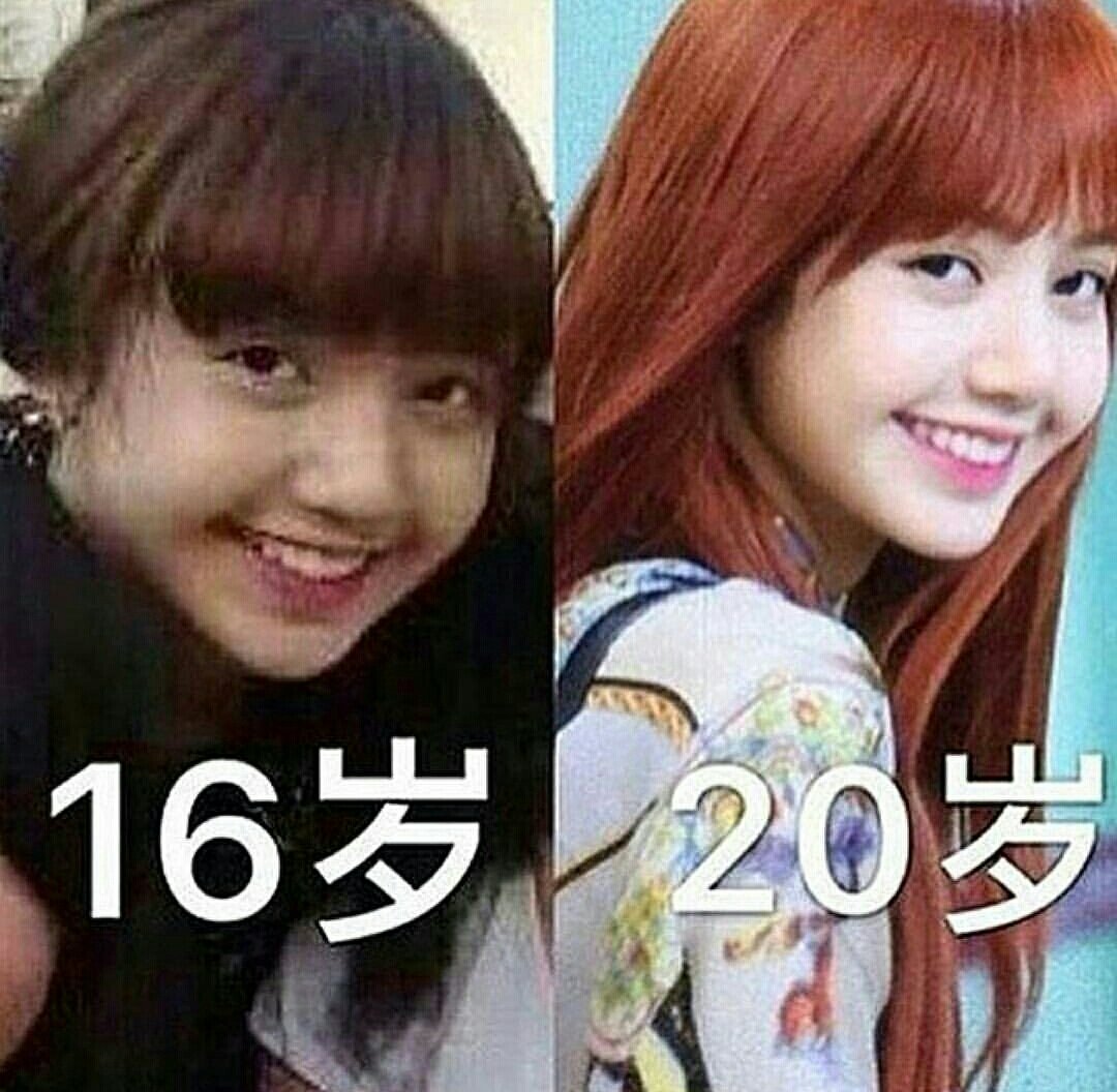 Blackpink lisa plastic surgery in the usa. 