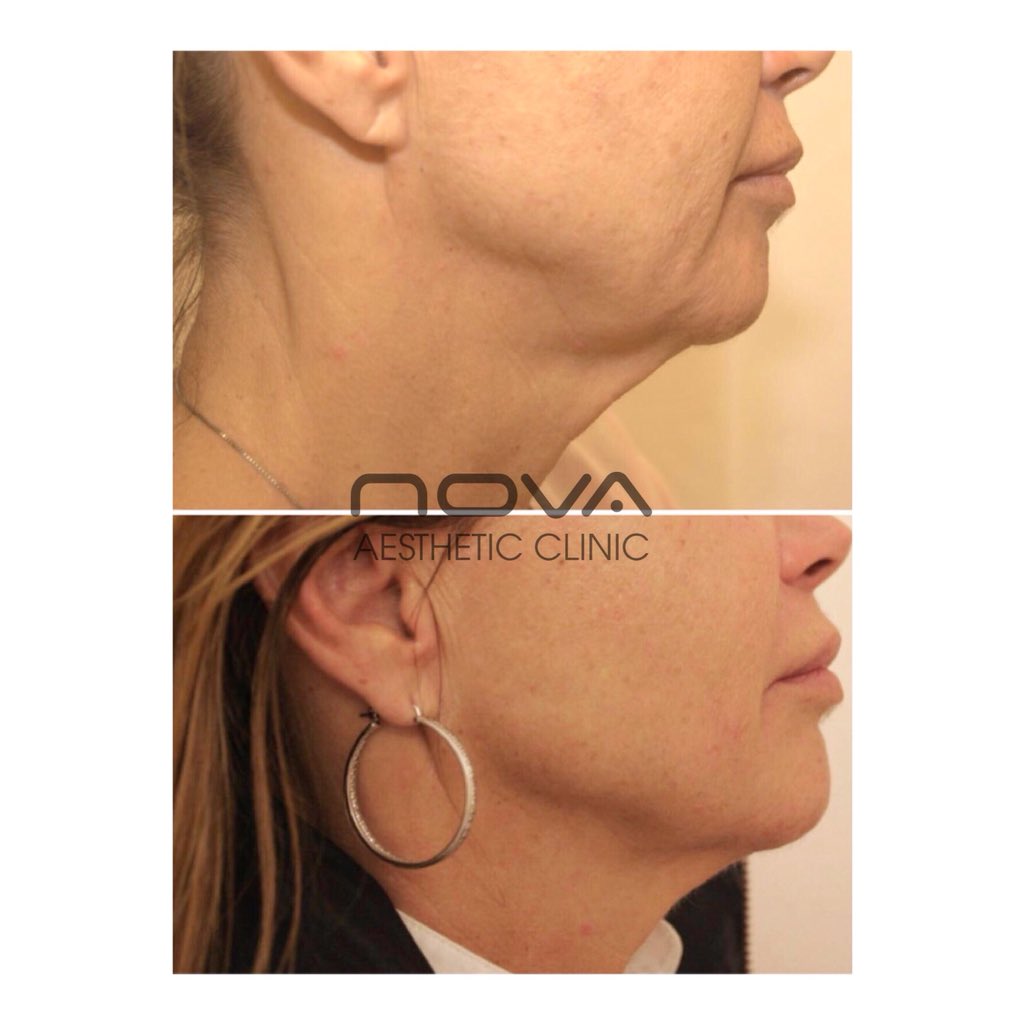 ✨ULTRAFORMER III HIFU at Nova✨ What an amazing jawline transformation after just ONE session of Ultraformer III HIFU! This “after” photo is FIVE months after a single treatment! 😱😍 #Hifu #ultraforma #greenwich #jawlinegoals #beauty