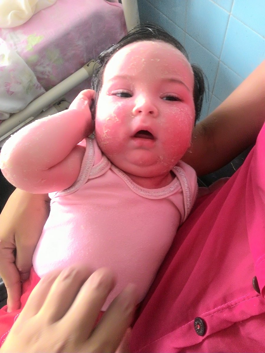 fundacionjesed's tweet photo. Valeria González edad 5 meses su diagnóstico es Eritrodermia se encuentra en el 6to piso Hospital de #cumaná , al momento de la visita no tenía antibiótico  ya que su mami no cuenta con recursos, le donamos 2 ampollas de oxacilina. Aún necesita ayuda @AnonMundial @abreudaniela26 https://t.co/t8cWTpbel4