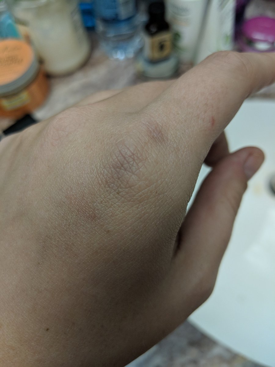 EmmiEmmiBoBemmi's tweet photo. Drank 2.5 bottles of wine throughout the day yesterday. Apparently at some point in the evening I ran into the open fridge door with my fist and just kept going. ๐
#goatderby https://t.co/nprj8UiCJS