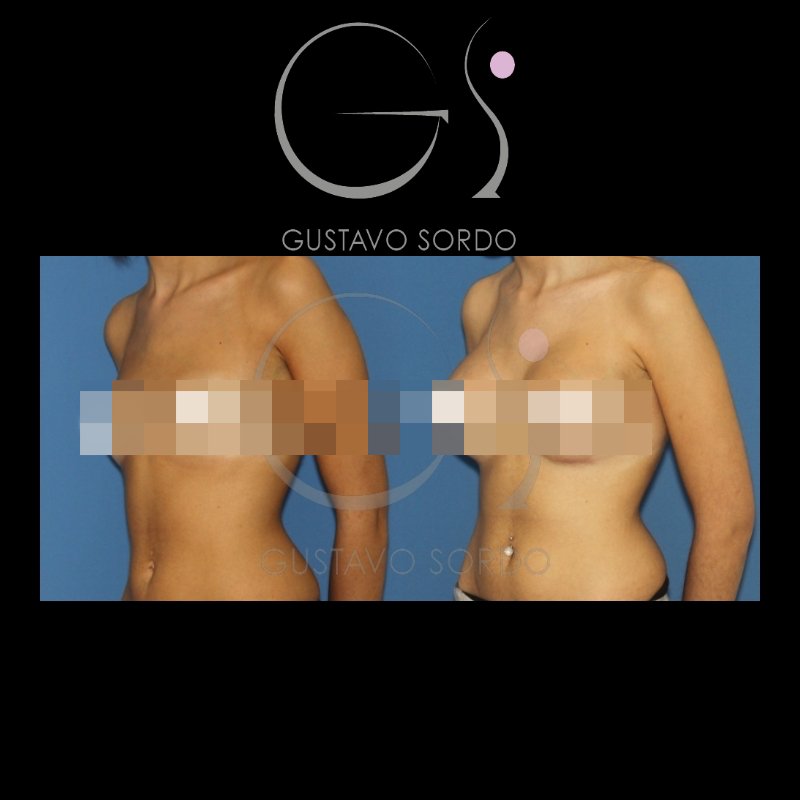 Caso de la semana: #Aumentodemamas con #prótesis redondas. Técnica: Aumento de mamas 24h recovery. Resultado: Conseguimos compensar los polos gracias a los implantes redondos de perfil moderado. ow.ly/OF7q30jQr3x