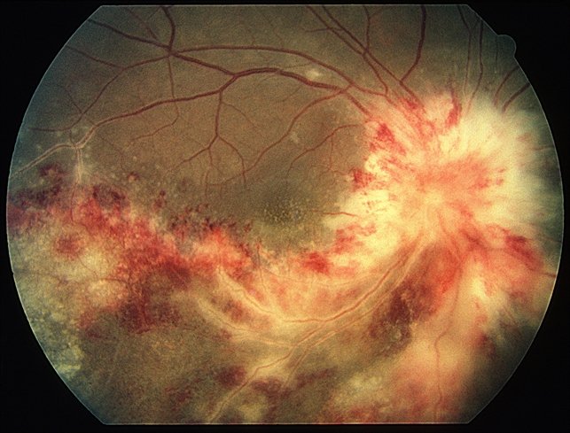 OphthalmoNeuro's tweet photo. Cytomegalovirus (CMV) #retinitis is a sight-threatening disease associated with AIDS — a serious disease of the immune system caused by infection with HIV
#Neurology #Ophthalmology #Diplopia #Acupuncture #Papilledema 
Share your research under this track https://t.co/ezoIf9g3CN https://t.co/4I2VkPwe68