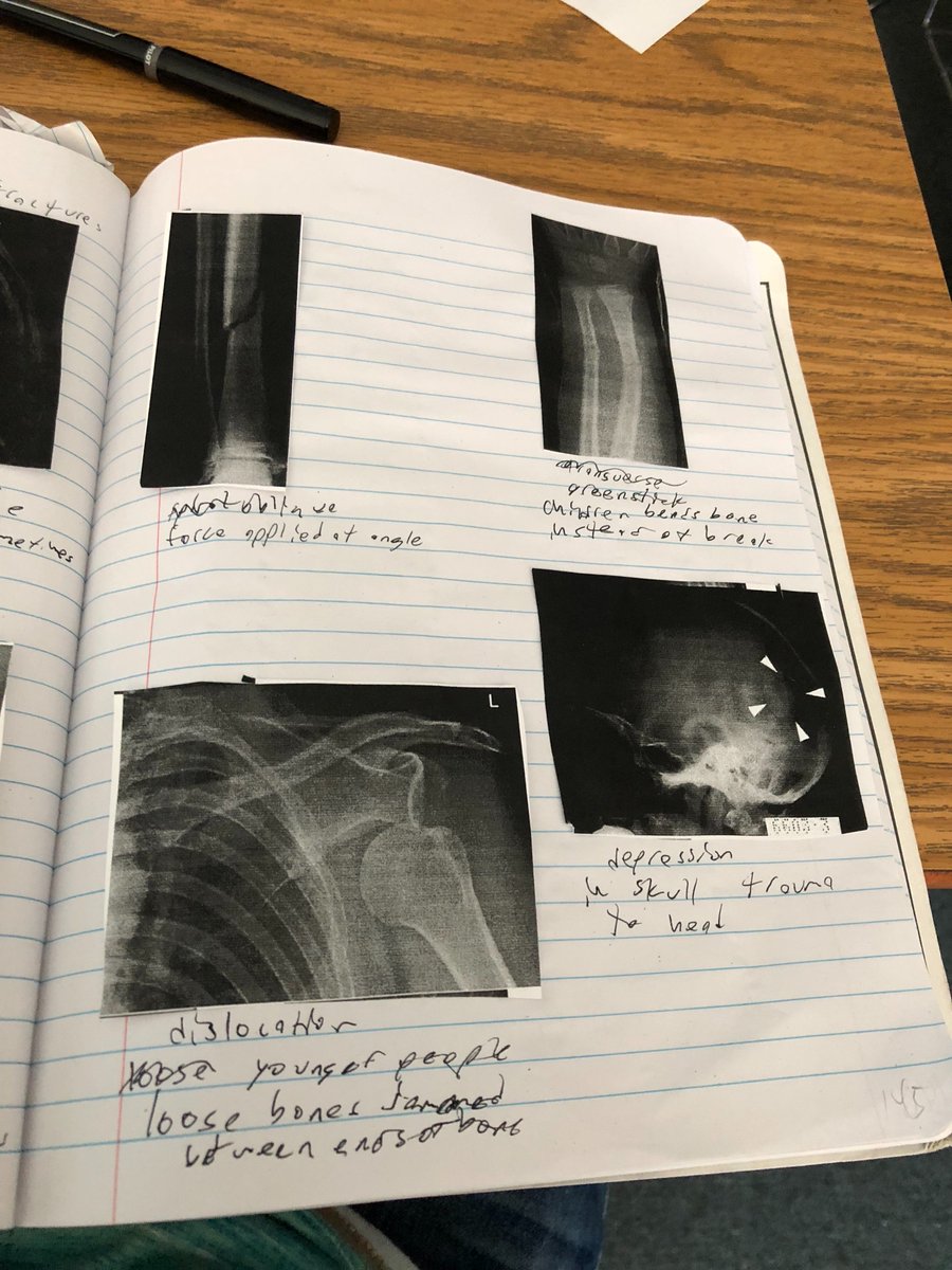 Vincent_Bio's tweet photo. #RHSBMS FRACTURE TYPES https://t.co/ZVEJXQHAef