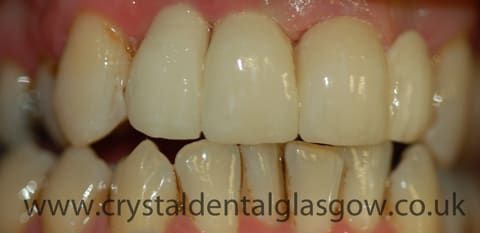 DentalCrystal's tweet photo. Check out this step by step story of a single tooth implant of an infected and badly discoloured tooth in our Glasgow practice.  https://t.co/dAFyB6owAD https://t.co/uLjImRx9WK