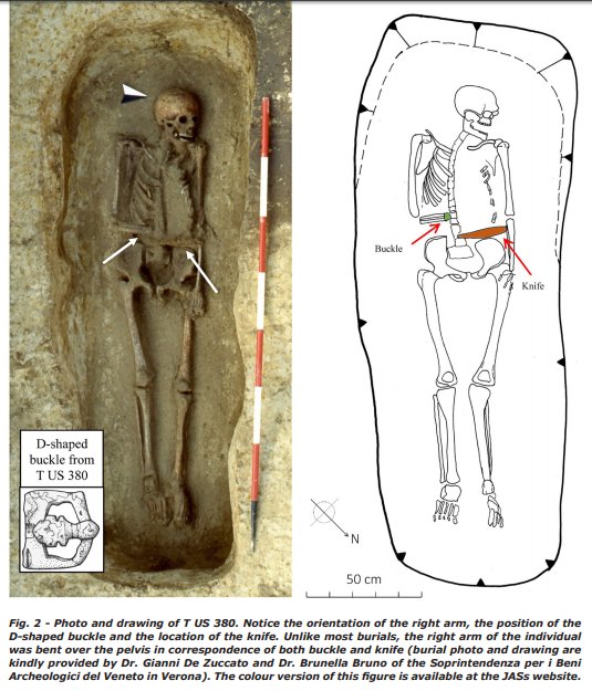 Près de Vérone, un squelette porte les stigmates d'une amputation réussie (entre 6e et 8e siècle) et probablement une prothèse avec une lame. isita-org.com/jass/Contents/… #lombard #moyenage #hautmoyenage #amputation #GameOfThrones