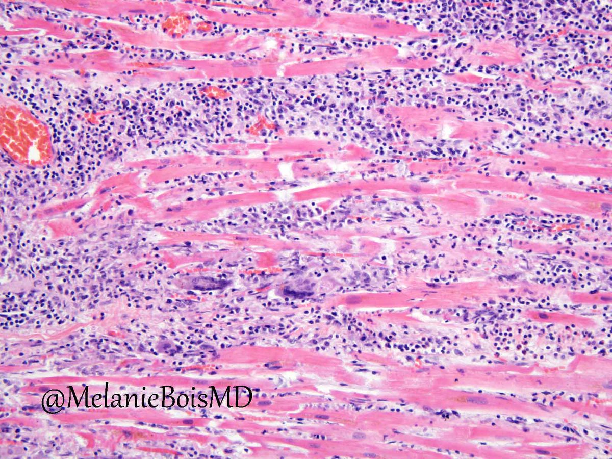 Giant cell myocarditis is associated with fulminant heart failure and poor patient prognosis. In addition to a robust lymphohistiocytic infiltrate, what other cell type is integral to this diagnosis? #cardiacpath #cvpath