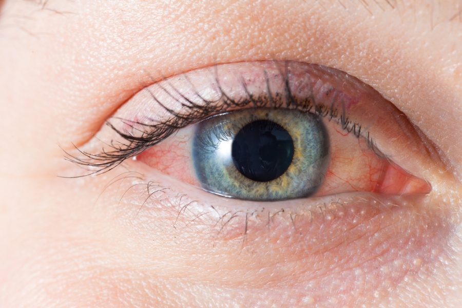 8 Reasons for Red Eyes and What to Do - healthiguide.com/beauty/8-reaso… - #FightAllergies #GetAdequateSleep #SwollenEyes #TroubleSleeping - #Beauty #Health