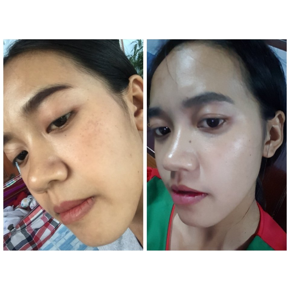 benz81608556's tweet image. 🗣แต่ก่อนมีฝ้าหนาสุดๆ😫
จนได้มาเจอ Spelling❤
🍊เซรั่มวิตซีช่วยลดสิว ฝ้า กระ รอยด่างดำ จากใบหน้าให้กระจ่างใส
🍼สลีปมาร์คบำรุงฟื้นฟูหน้าติดสารให้กลับมาแข็งแรง
📌จากหน้าที่แห้งเป็นฝ้าหนาเกรอะ ตอนนี้ดีขึ้นมากๆ ใช้เองจริง หายจริง 
#ใช้ดีบอกต่อ  #HowtoPerfect #ใช #HowtoPerfect