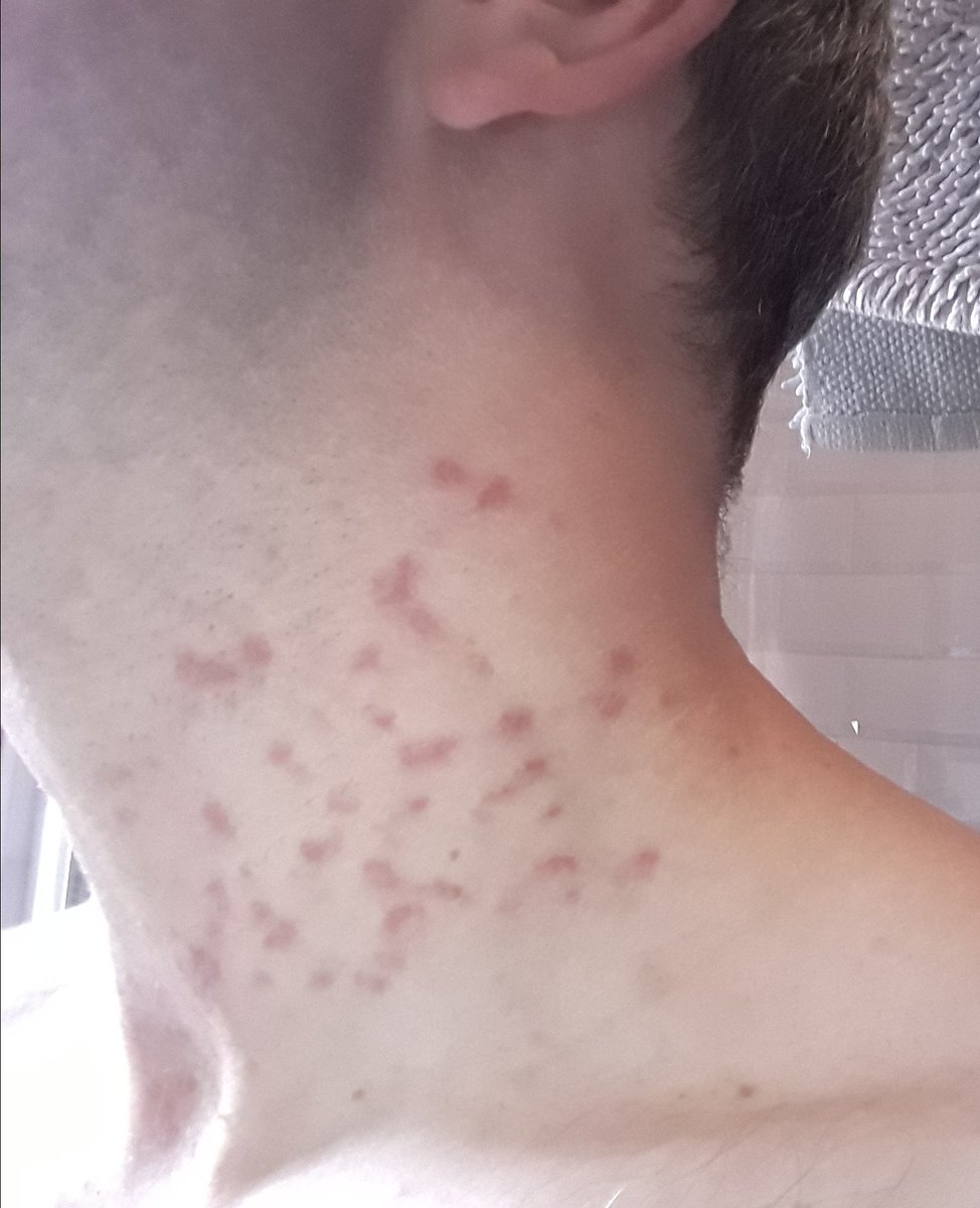 apauctioneers's tweet photo. Wasn't thinking when I decided to strim the garden in a T shirt on Saturday morning, been covered in rash since now turning to blisters....and I was aware of the dangers @gianthogweeduk off to doctor this afternoon, apologies for the graphic photos #gianthogweed #discomfort https://t.co/8XBZRSoA4g