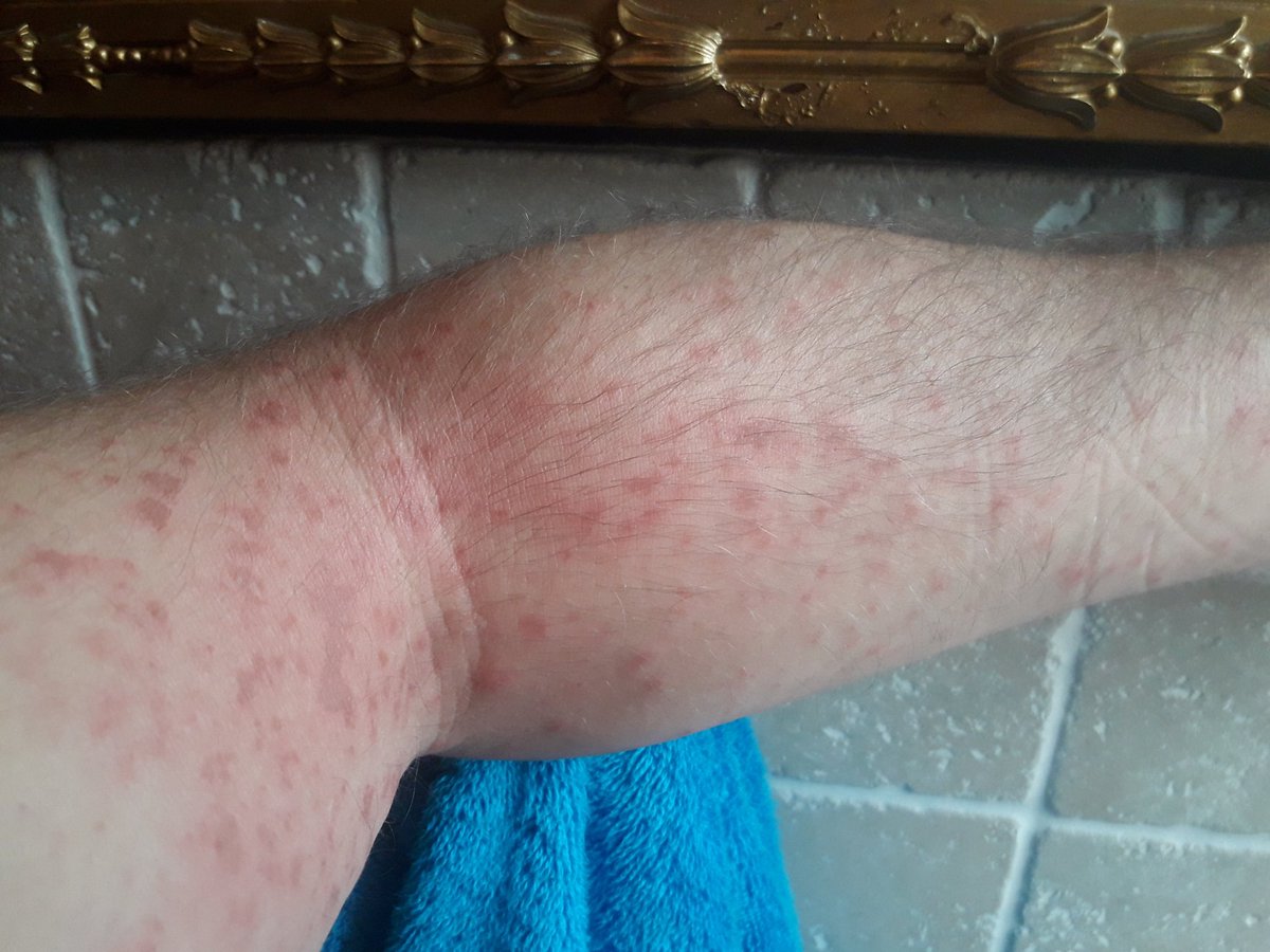 apauctioneers's tweet photo. Wasn't thinking when I decided to strim the garden in a T shirt on Saturday morning, been covered in rash since now turning to blisters....and I was aware of the dangers @gianthogweeduk off to doctor this afternoon, apologies for the graphic photos #gianthogweed #discomfort https://t.co/8XBZRSoA4g