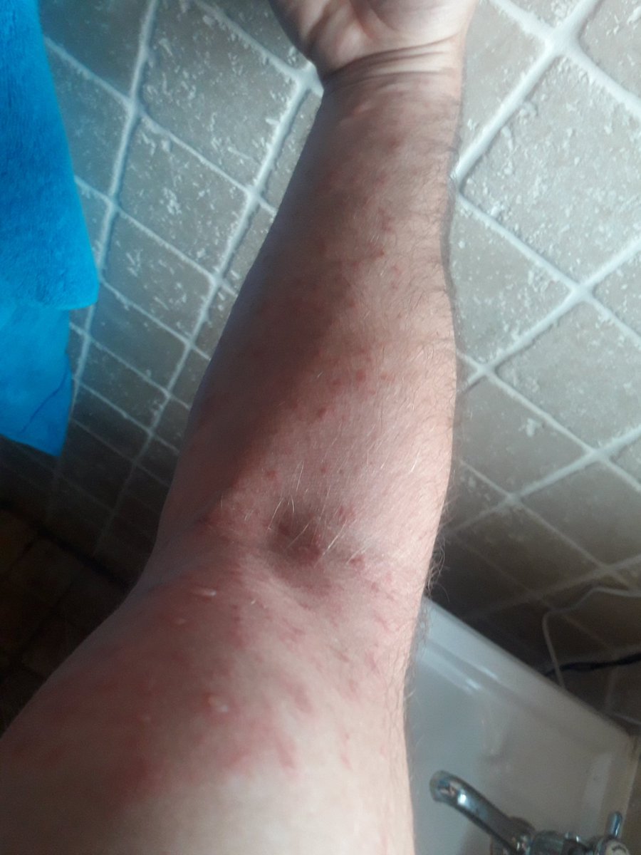 apauctioneers's tweet photo. Wasn't thinking when I decided to strim the garden in a T shirt on Saturday morning, been covered in rash since now turning to blisters....and I was aware of the dangers @gianthogweeduk off to doctor this afternoon, apologies for the graphic photos #gianthogweed #discomfort https://t.co/8XBZRSoA4g